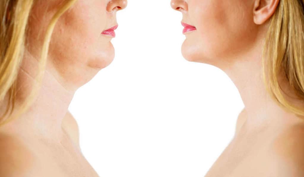 Double Chin treatment Newark-on-Trent before and after results