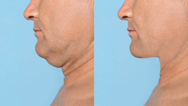 Which Non-Surgical Treatments Work Best for Jowls and Loose Skin Newark-on-Trent?