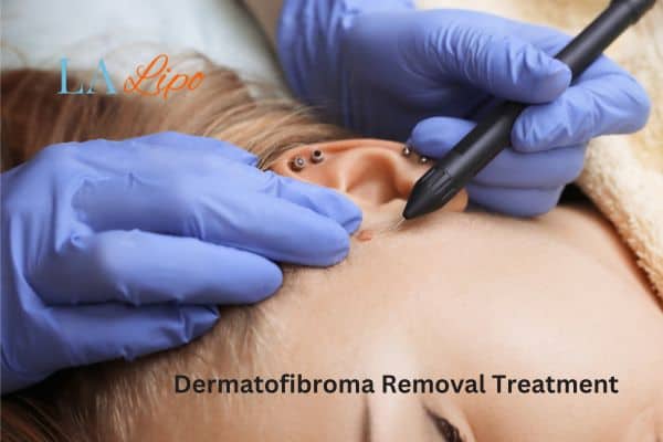 Dermatofibroma Removal Treatment Newark-on-Trent