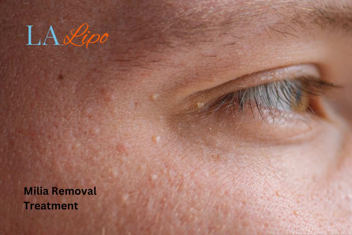 Cryopen Milia Removal: Is It the Easiest and Safest Option Newark-on-Trent?