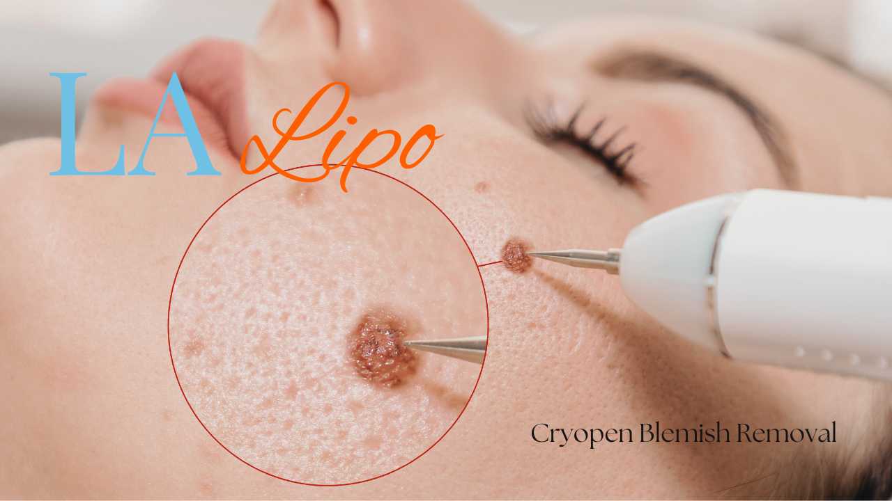 cryopen blemish removal Newark-on-Trent Contact our team today!