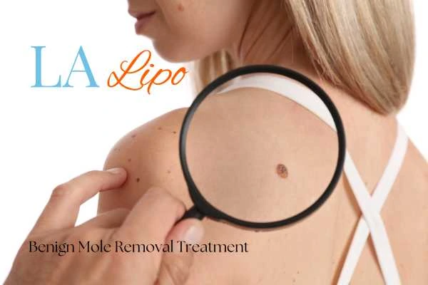 Woman having her inspection of blemish before mole removal Newark-on-Trent