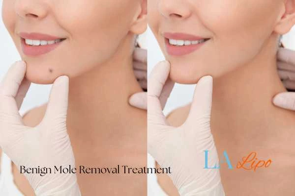 woman's before and after mole removal Newark-on-Trent results