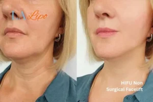 hi-fu for wrinkles Newark-on-Trent before and after results