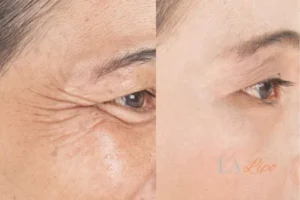 Before and after results of woman - HI-fu wrinkles reduction treatment Newark-on-Trent