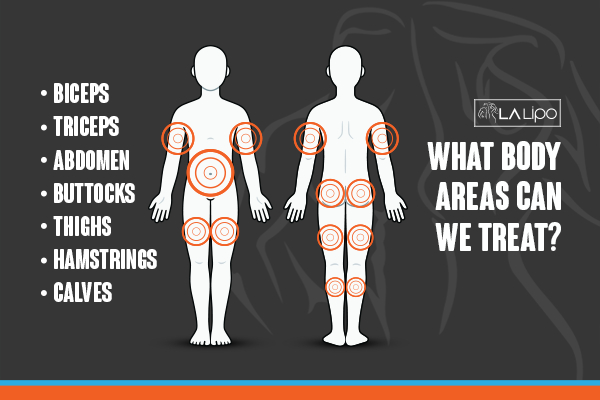 Graphic to show areas you can have LA-EMS Body Sculpting Newark-on-Trent treatment.