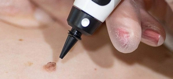 skin tag removal using cryopen Newark-on-Trent