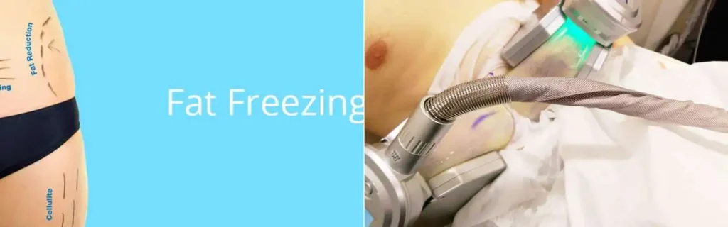 Fat freezing Newark-on-Trent on multiple areas of the body