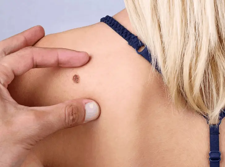 woman having mole removal Newark-on-Trent consultation before treatment.