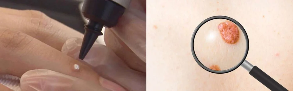 CryoPen practitioner Newark-on-Trent assessing a benign mole before treatment