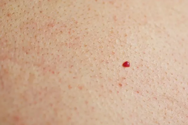 close up of a cherry angioma Newark-on-Trent