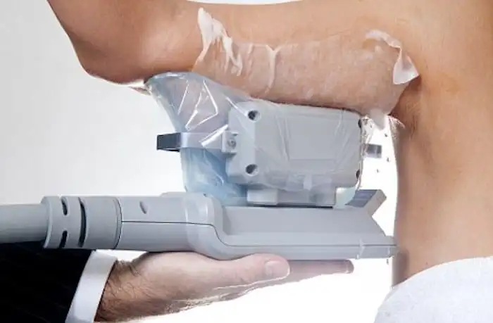 Picture of fat freezing Newark-on-Trent on the upper arms.