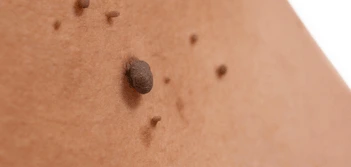 image of a skin tag Newark-on-Trent