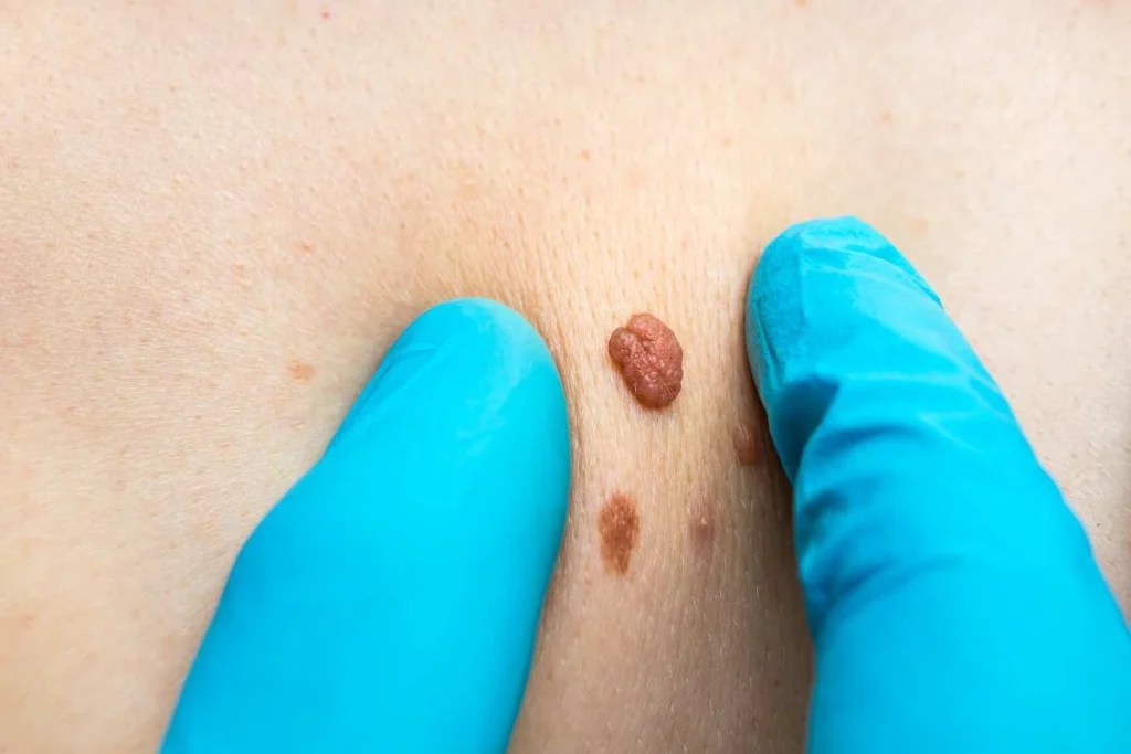 Consultant examining a skin tag Newark-on-Trent