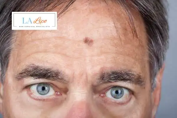 Solar Lentigo Removal Newark-on-Trent image of man with mark on his forehead