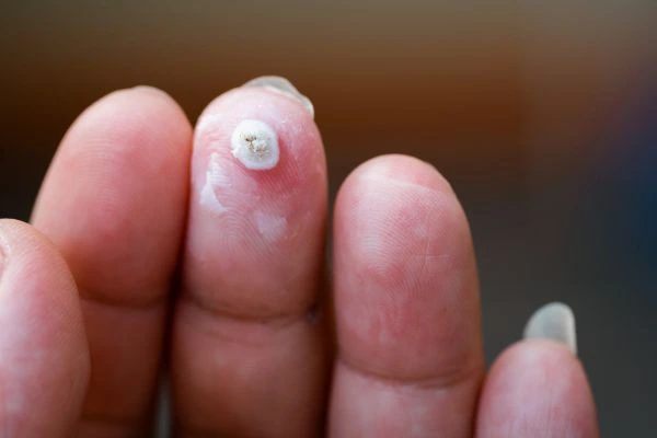 wart on person finger - cryotherapy to treat from LA LIPO Newark-on-Trent