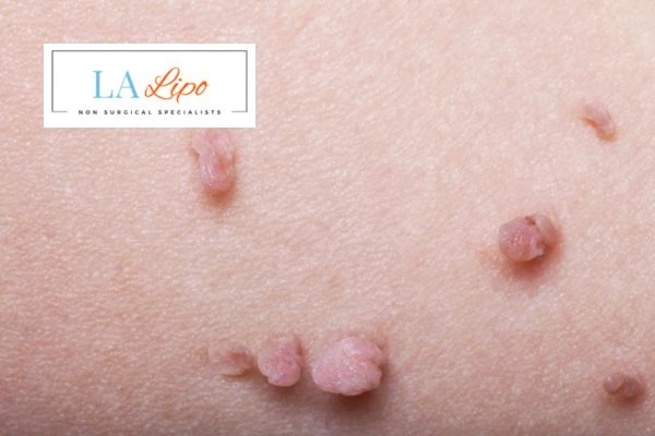 Does cryopen skin tag removal Newark-on-Trent hurt? Find out now call our team today!