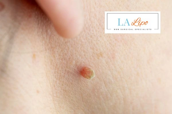 Book skin tag removal Newark-on-Trent today speak to our team now!