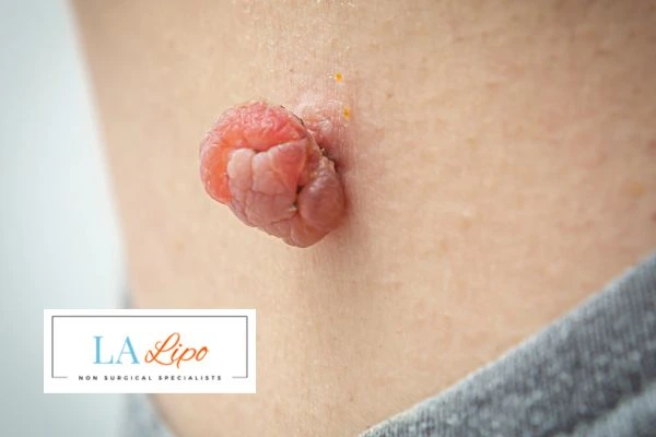 Interested in skin tag removal Newark-on-Trent? Concerned about the pain? Find out more today!