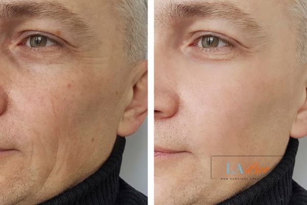 See the amazing results of Morpheus8 Treatment Newark-on-Trent!