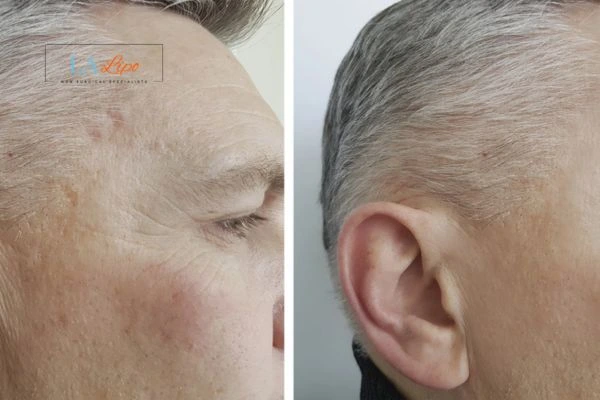 Mens Before & After Morpheus 8 Results Newark-on-Trent