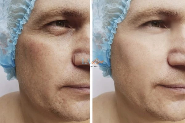 Before and after Morpheus 8 Results Newark-on-Trent