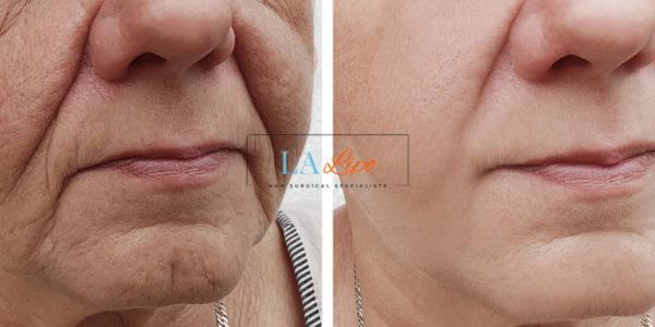 Older lady deeper wrinkle reduction - LA LIPO Morpheus 8 Results Newark-on-Trent