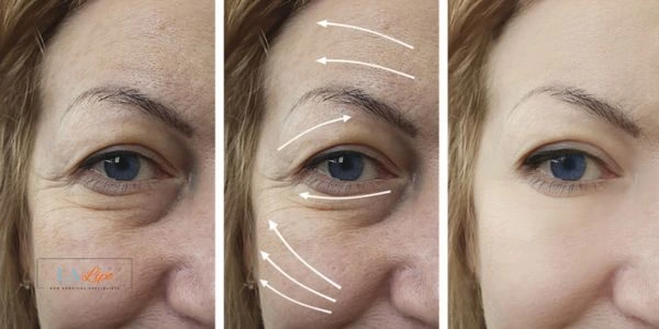 Amazing eye lift Morpheus 8 results Newark-on-Trent