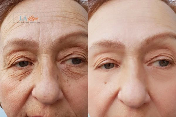 The powerful benefits of Morpheus8 Treatment Newark-on-Trent - Call Our team today!