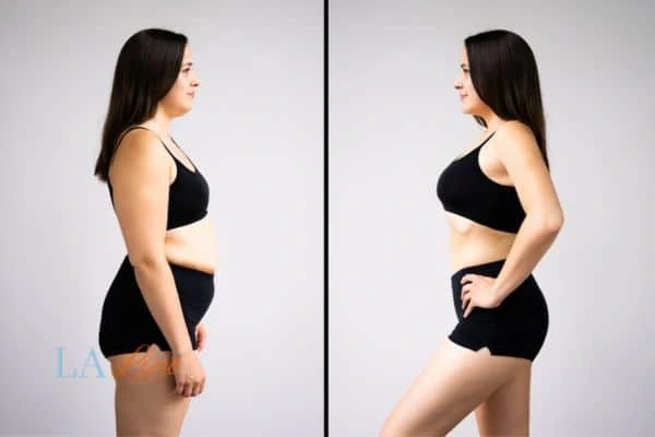 Picture of womans before and after using LA-EMS body sculpting to improve her core strength Newark-on-Trent