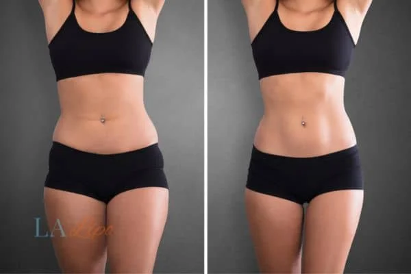 before and after results of non-surgical treatment to help a woman's body image and mental health Newark-on-Trent