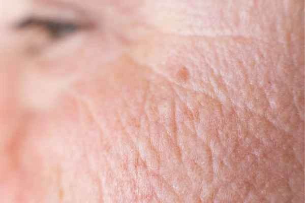 close up picture of a woman's face showing an age spot Newark-on-Trent