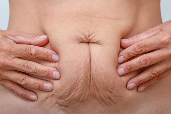 Should I Combine Diastasis Recti Treatment with Body Contouring for Better Results Newark-on-Trent?