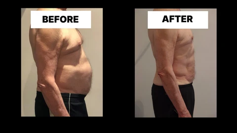 What Symptoms Can Diastasis Recti Cause in Men? Weak Core, Back Pain and Poor Posture Newark-on-Trent